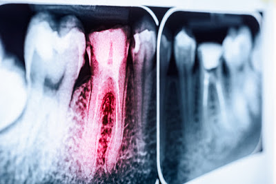 Πώς και πότε οι ρίζες των δοντιών προσβάλλονται από τερηδόνα; - Φωτογραφία 1
