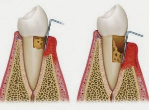 Πώς και πότε οι ρίζες των δοντιών προσβάλλονται από τερηδόνα; - Φωτογραφία 2