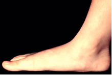 Αναγνωρίστε κοινά προβλήματα των ποδιών σας, όπως κάλοι, κότσι, μύκητες, μυρμηγκιές - Φωτογραφία 10