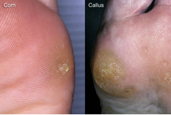 Αναγνωρίστε κοινά προβλήματα των ποδιών σας, όπως κάλοι, κότσι, μύκητες, μυρμηγκιές - Φωτογραφία 3