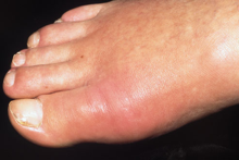Αναγνωρίστε κοινά προβλήματα των ποδιών σας, όπως κάλοι, κότσι, μύκητες, μυρμηγκιές - Φωτογραφία 4