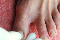 Αναγνωρίστε κοινά προβλήματα των ποδιών σας, όπως κάλοι, κότσι, μύκητες, μυρμηγκιές - Φωτογραφία 6