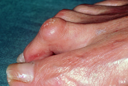 Αναγνωρίστε κοινά προβλήματα των ποδιών σας, όπως κάλοι, κότσι, μύκητες, μυρμηγκιές - Φωτογραφία 8