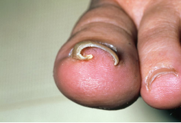 Αναγνωρίστε κοινά προβλήματα των ποδιών σας, όπως κάλοι, κότσι, μύκητες, μυρμηγκιές - Φωτογραφία 9