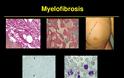 Αιματολογικοί καρκίνοι, Μυελοϋπερπλαστικά Νεοπλάσματα. Μυελοΐνωση, Αληθής Πολυκυτταραιμία, Ιδιοπαθής Θρομβοκυττάρωση - Φωτογραφία 5