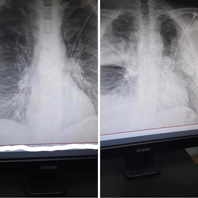 Σοκάρει ακτινογραφία πνευμόνων ασθενούς με κοροναϊό, με διαφορά ωρών - Φωτογραφία 1