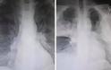 Σοκάρει ακτινογραφία πνευμόνων ασθενούς με κοροναϊό, με διαφορά ωρών