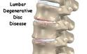 Παγκόσμια Ημέρα Σπονδυλικής Στήλης. Οι πόνοι της μέσης, οι κακώσεις της σπονδυλικής στήλης και η σημασία της σωστής στάσης - Φωτογραφία 3