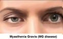 Μυασθένεια Gravis με βλεφαρόπτωση, κόπωση, μυϊκή αδυναμία (video) - Φωτογραφία 4