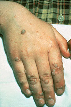 Κονδυλώματα, μυρμηγκιές, Human PapillomaVirus HPV. Tρόπος μετάδοσης; Εμβολιασμός και πρόληψη - Φωτογραφία 5