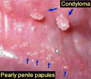 Κονδυλώματα, μυρμηγκιές, Human PapillomaVirus HPV. Tρόπος μετάδοσης; Εμβολιασμός και πρόληψη - Φωτογραφία 7