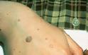 Κονδυλώματα, μυρμηγκιές, Human PapillomaVirus HPV. Tρόπος μετάδοσης; Εμβολιασμός και πρόληψη - Φωτογραφία 5