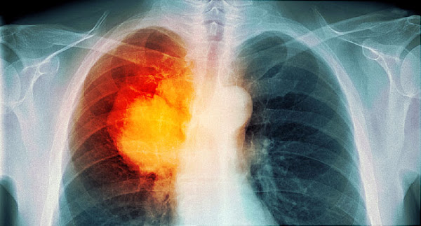Καρκίνος του πνεύμονα, μια κορυφαία θεραπεία είναι η ανοσοθεραπεία - Φωτογραφία 1