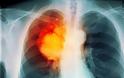 Καρκίνος του πνεύμονα, μια κορυφαία θεραπεία είναι η ανοσοθεραπεία