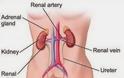 Πόνος στη μέση από τα νεφρά; Πέτρα στους νεφρούς, νεφρολιθίαση, οξεία νεφρική ανεπάρκεια - Φωτογραφία 2