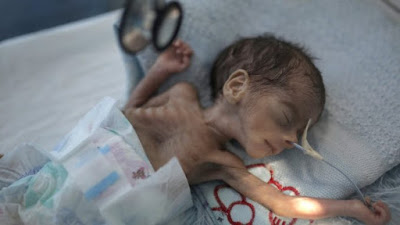 Δράμα στην Υεμένη Σε πρωτόγνωρα επίπεδα οξέος υποσιτισμού εκατομμύρια παιδιά - Φωτογραφία 1
