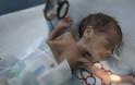 Δράμα στην Υεμένη Σε πρωτόγνωρα επίπεδα οξέος υποσιτισμού εκατομμύρια παιδιά