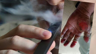 Έκρηξη μπαταρίας ηλεκτρονικού τσιγάρου του προκάλεσε σοβαρά εγκαύματα - Φωτογραφία 1