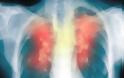 Τι είναι η Χρόνια Αποφρακτική Πνευμονοπάθεια; Πιθανά αίτια; Οδηγίες για όσους έχουν ΧΑΠ - Φωτογραφία 4
