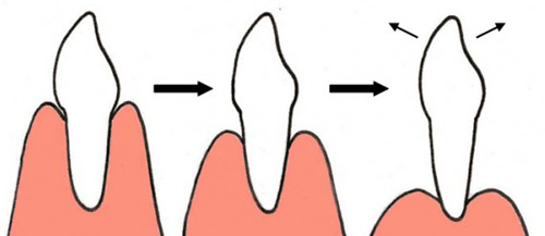 Γιατί ματώνουν τα ούλα και γιατί κουνιούνται τα δόντια; - Φωτογραφία 5