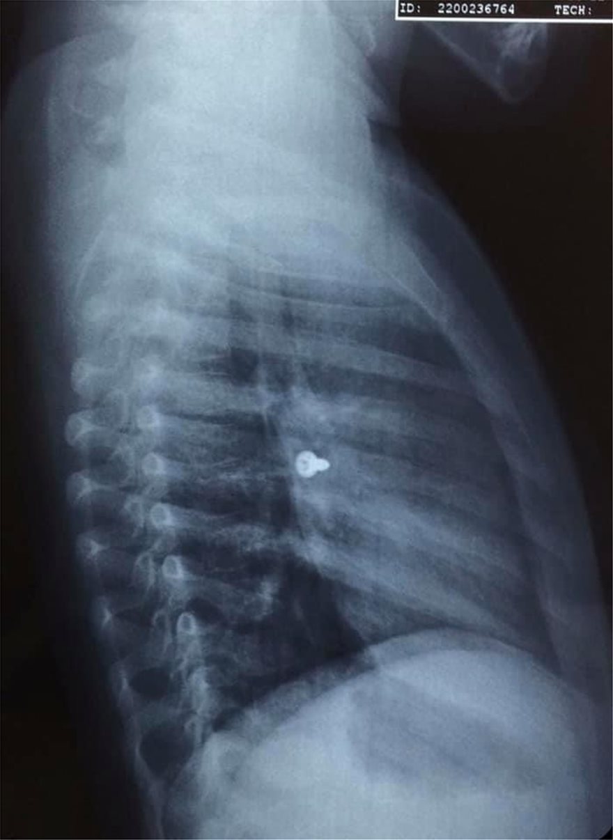 Κρήτη: Τρίχρονη κατάπιε βίδα που κατέληξε στον πνεύμονά της - Δείτε τις σοκαριστικές ακτινογραφίες - Φωτογραφία 2