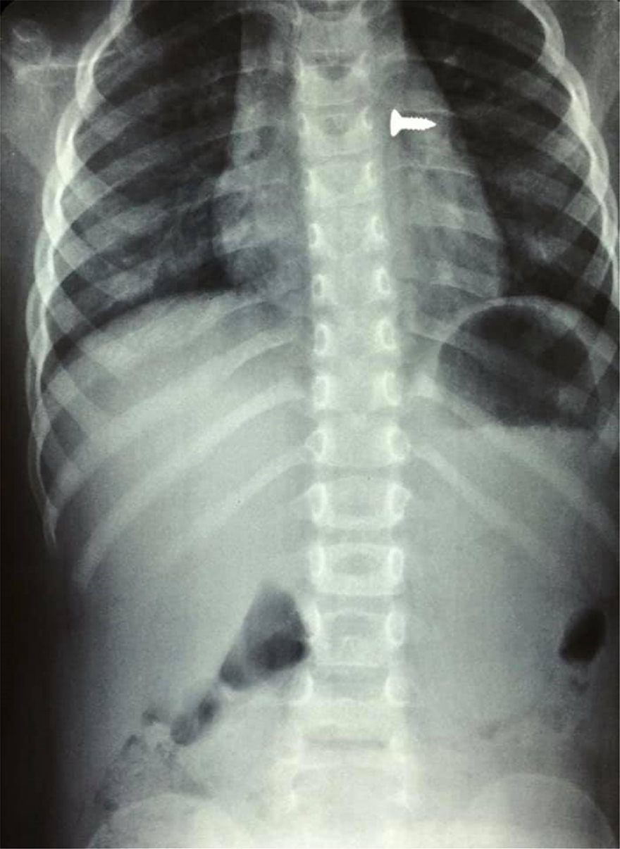 Κρήτη: Τρίχρονη κατάπιε βίδα που κατέληξε στον πνεύμονά της - Δείτε τις σοκαριστικές ακτινογραφίες - Φωτογραφία 3