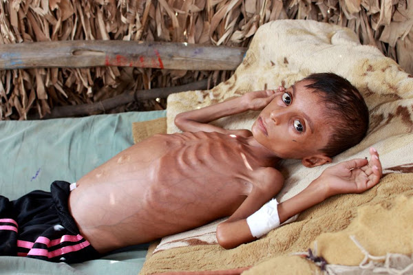 Εκατοντάδες χιλιάδες παιδιά θα πεθάνουν από πείνα λόγω της πανδημίας - Φωτογραφία 1