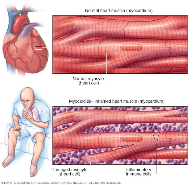 Μυοκαρδίτιδα: Τα συμπτώματα που πρέπει να σας κινητοποιήσουν - Φωτογραφία 2