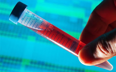 Απλή εξέταση αίματος εντοπίζει δεκάδες τύπους καρκίνου-Blood test for cancer - Φωτογραφία 1