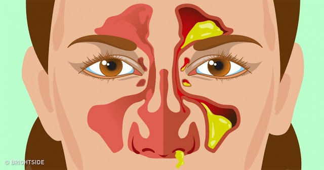 Τύποι εκκριμάτων της μύτης και τι δείχνουν για την υγεία σας - Φωτογραφία 1