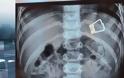 Λήμνος: Αγοράκι 2 ετών κατάπιε μανταλάκι. Οι γιατροί το αφαίρεσαν χωρίς χειρουργείο