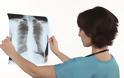 Ανατροπή από νέα ευρήματα: Η φυματίωση μεταδίδεται απλώς με την αναπνοή, όχι μόνο με τον βήχα