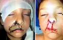 Σοκ:11χρονο κοριτσάκι δέχτηκε επίθεση απο σκύλο την ώρα που κοιμόταν