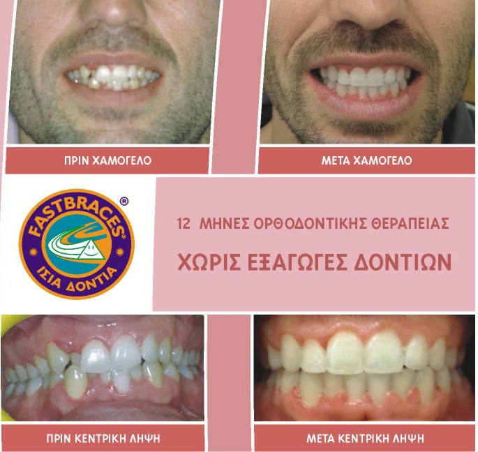 Ίσια δόντια με το σύστημα Fastbraces - Φωτογραφία 10