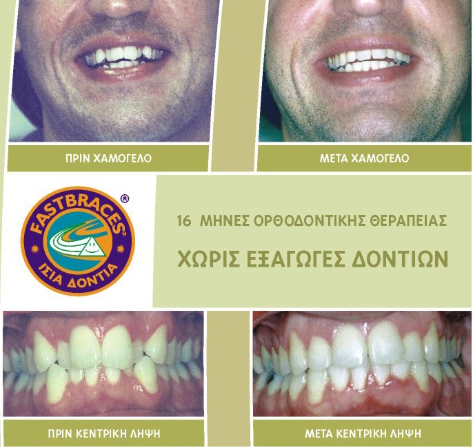 Ίσια δόντια με το σύστημα Fastbraces - Φωτογραφία 8