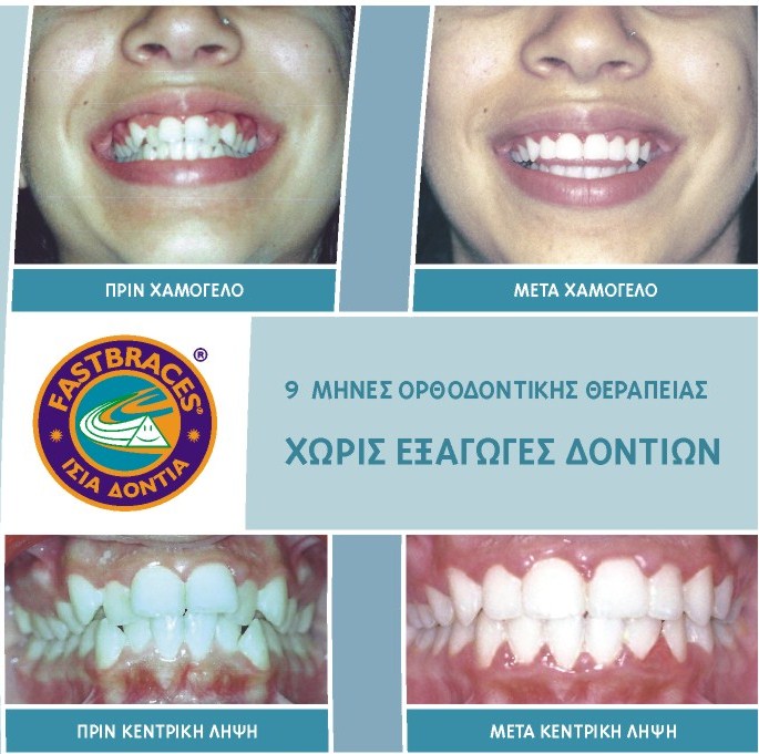 Ίσια δόντια με το σύστημα Fastbraces - Φωτογραφία 9