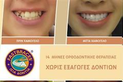Ίσια δόντια με το σύστημα Fastbraces