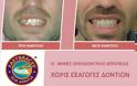 Ίσια δόντια με το σύστημα Fastbraces - Φωτογραφία 10