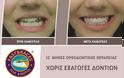 Ίσια δόντια με το σύστημα Fastbraces - Φωτογραφία 6