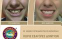 Ίσια δόντια με το σύστημα Fastbraces - Φωτογραφία 7