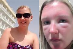 ΣΟΚΑΡΙΣΤΙΚΟ : Να τι μπορείς να πάθεις αν φοράς γυαλιά ηλίου.. μαιμού!