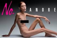 ΣΚΛΗΡΕΣ ΕΙΚΟΝΕΣ: 10 σοκαριστικές περιπτώσεις ανορεξίας