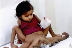 ΔΕΙΤΕ: Το παιδί που γεννήθηκε με οκτώ άκρα