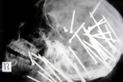 ΑΠΙΣΤΕΥΤΟ: Ακτινογραφίες που σοκάρουν!