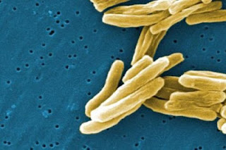 Πέντε παιδιά βρέθηκαν θετικά στη φυματίωση - Φωτογραφία 1