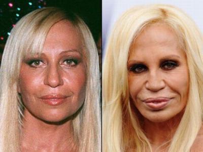 Celebrities πριν και μετά την πλαστική...  [ΦΩΤΟ] - Φωτογραφία 1