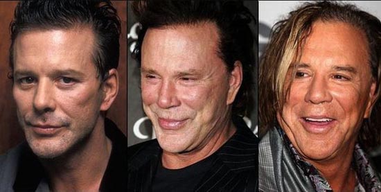 Celebrities πριν και μετά την πλαστική...  [ΦΩΤΟ] - Φωτογραφία 11