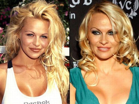 Celebrities πριν και μετά την πλαστική...  [ΦΩΤΟ] - Φωτογραφία 12