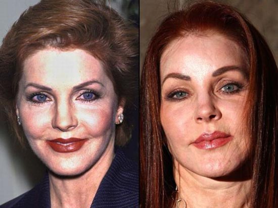 Celebrities πριν και μετά την πλαστική...  [ΦΩΤΟ] - Φωτογραφία 20