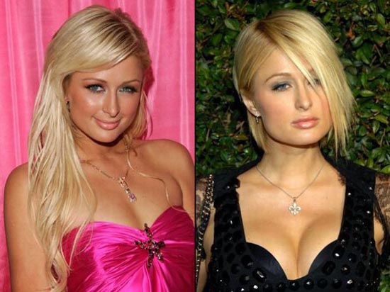 Celebrities πριν και μετά την πλαστική...  [ΦΩΤΟ] - Φωτογραφία 4